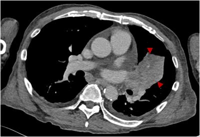 Case report: Strong GAD antibody positivity and type 1 diabetes-HLA-susceptible haplotype-DRB1*04:05-DQB1*04:01 in a Japanese patient with immune checkpoint inhibitor-induced type 1 diabetes